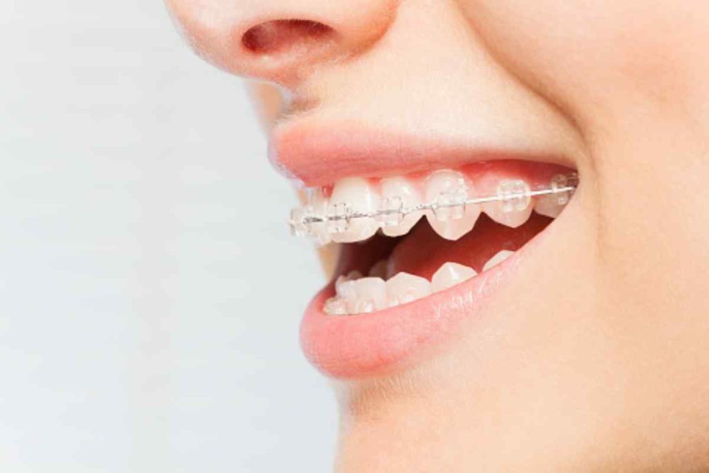 The Benefits of Ceramic Braces Straightening Your Teeth with Style