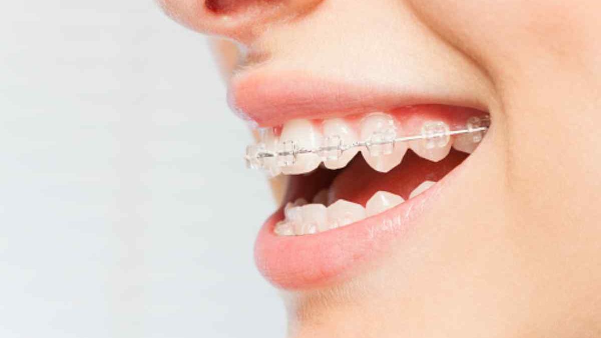 The Benefits of Ceramic Braces: Straightening Your Teeth with Style