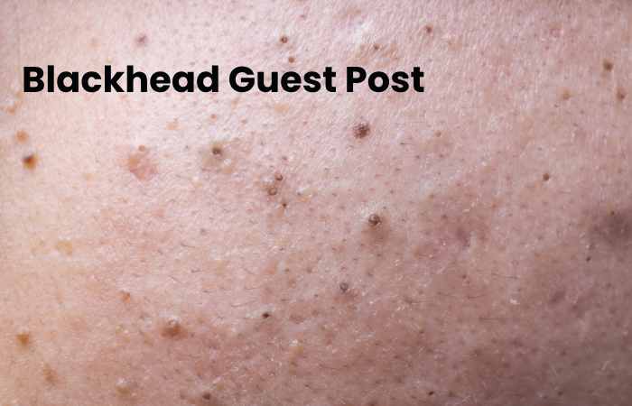 Blackhead Guest Post