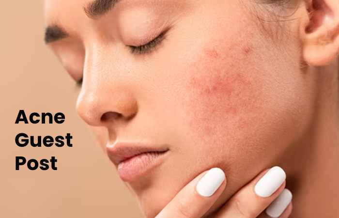 Acne Guest Post 