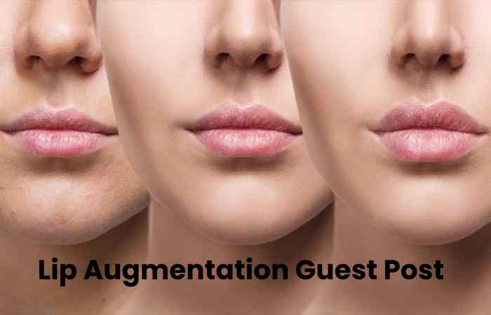 Lip Augmentation Guest Post